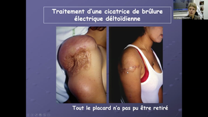 DU de chirurgie plastique pédiatrique Pr Véronique Martinot, Expansion cutanées 03/02/2021