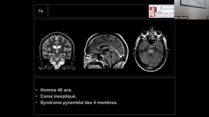 11/05/2023	16h00	18h00	ED neuroradiologie 	MENJOT DE CHAMPFLEUR Nicolas	301	DFASM1