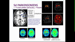 DFGSM2 - Pr.Mariano Goulart - Imagerie métabolique et moléculaire cérébrale SPECT et PET - 01/04/2025