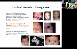 DU de chirurgie plastique pédiatrique Dr Véronique Soupre Anomalies vasculaires des téguments 03/02/2021