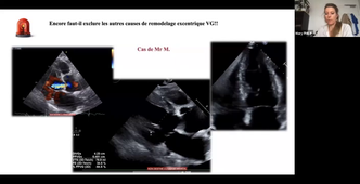 Dr PHILIP- Insuffisance aortique - quantification - retentissement-indications chir.mp4