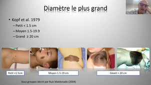 DU de chirurgie plastique pédiatrique Pr Guillaume Captier, Naevus Mélanocytaire Congénital 05/02/2021