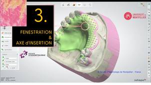 3SHAPE2025_PPAM MX 03 fenestration.mp4