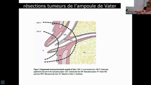 Tumeur du duodénum - Pr HARDWIGSEN.mp4