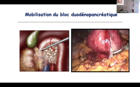 Ampullectomie - Pr BORIE.mp4