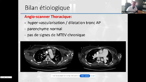 Imagerie multimodalités dans l’Hypertension Pulmonaire_Dr RENARD.mp4
