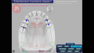 Tracé maxillaire Classe I vitesse accélérée