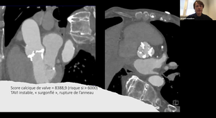 Evaluation avant, pendant et après TAVI - Dr MAUDIERE