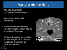 Traumatisme du massif facial