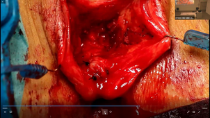 VIDEOS CHIR PARTIE 2.mp4