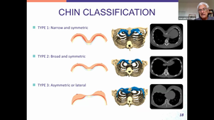 Pectus excavatum - Pr Chavoin (DUC de CPP) (04/12/2020)