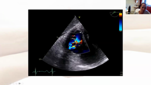 Echographie imagerie et transplantation cardiaque.mp4
