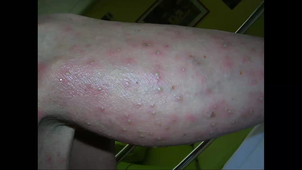 31/03/2021	14:00	17:00	DFGSM3 : Revêtement cutané : Flore cutanée / Infections cutanées bactérienne, virale, mycologique -Gale et pédiculoses (CM16)	Aurélie DU THANH	Amphi Rabelais	DFGSM3
