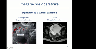07/04/2021	11:00	12:00	Cancer de l'ovaire	FRANCINI Sarah	308		MIE