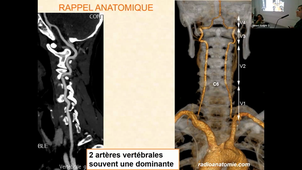 Dissection Vertebrale Dr florence TAHON.mp4