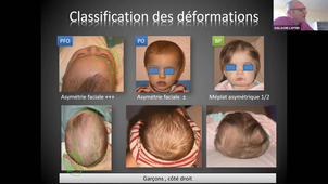 DU de chirurgie plastique pédiatrique Pr Captier, Torticolis et déformation crânienne 07/04/2021