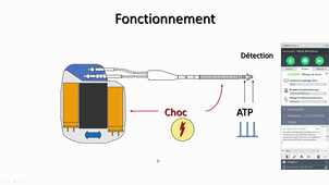 Dr JL PASQUIE - DAI et CRT : Le point dans l'IC