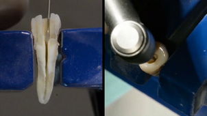 Traitement endodontique sur premolaire